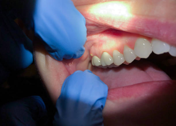 Urgent Tooth Repair in SC